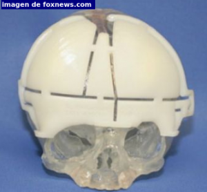 implante cráneo